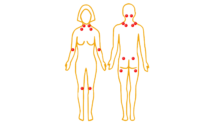 Pijnpunten van fibromyalgie