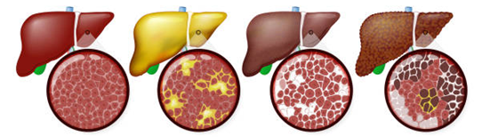 Illustratie van vier stadia van levergezondheid: gezonde lever, lever met vetopslag, lever met fibrose en lever met cirrose.